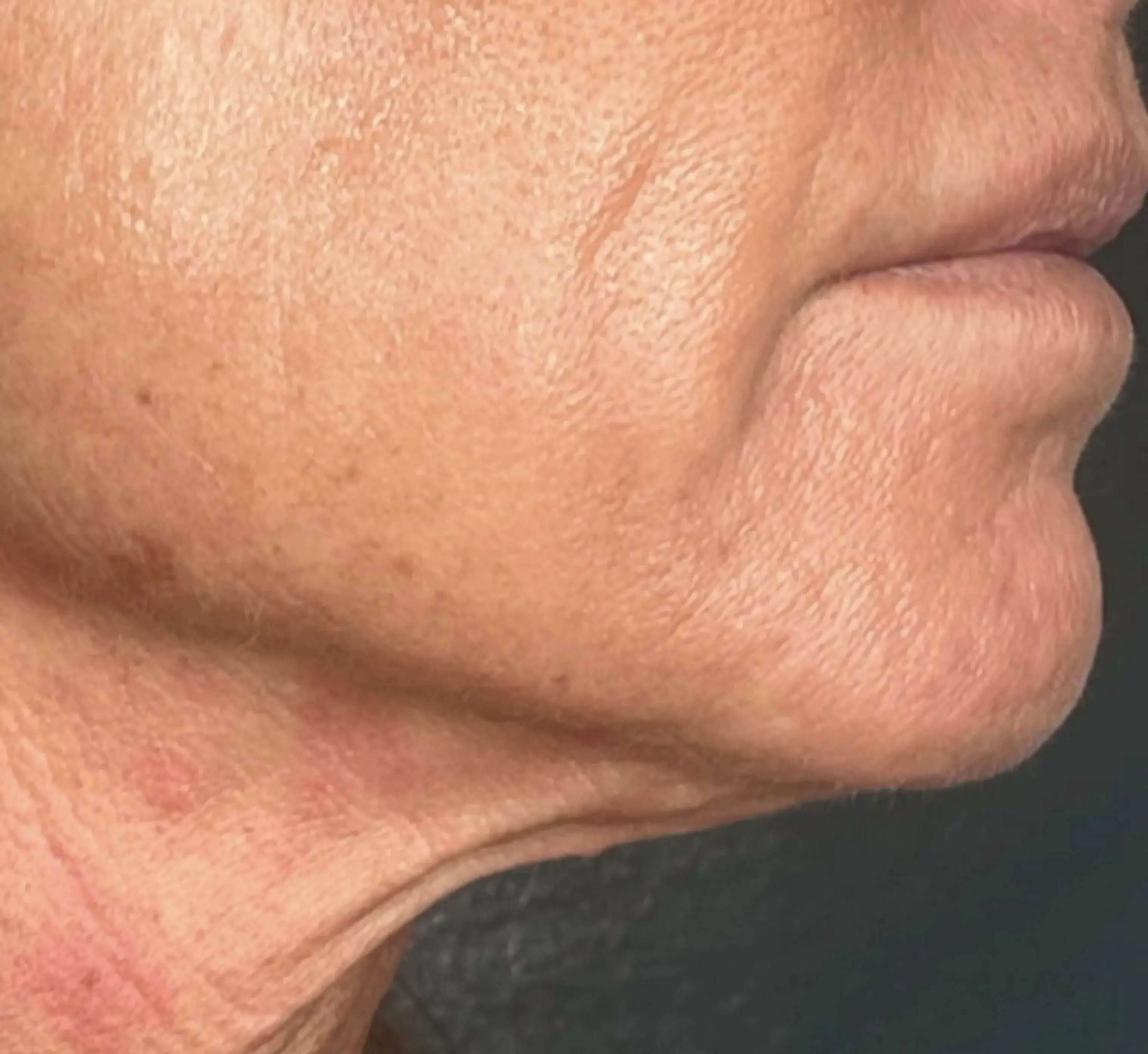 Neck & jawline after DENSITY RF treatment
