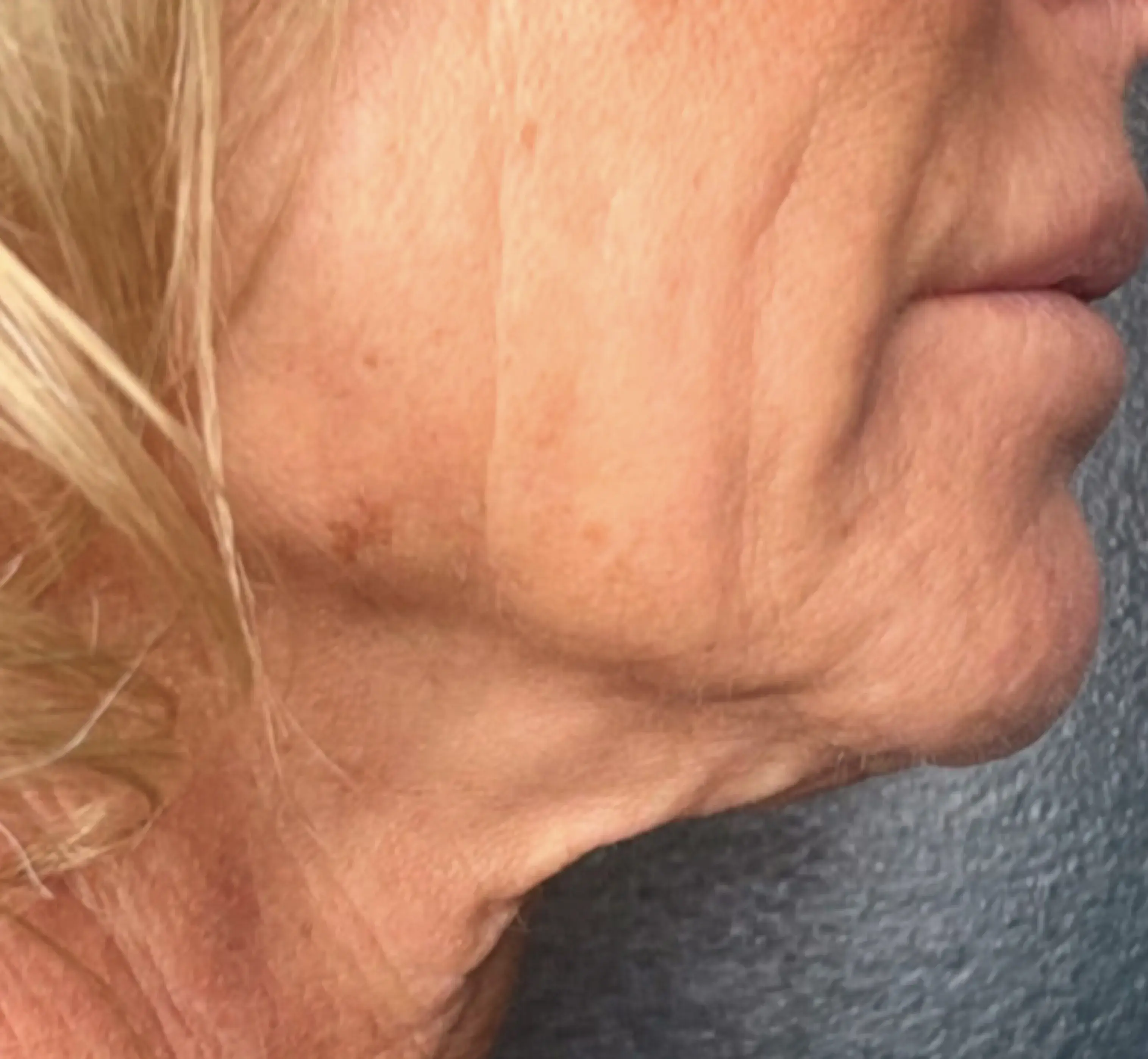 Neck & jawline before DENSITY RF treatment
